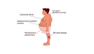 Cushing's Disease